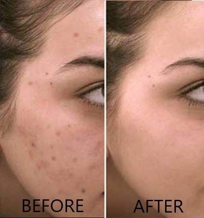 Vitamin C Serum 20% Pure L-Ascorbic Acid, Ferulic Acid, Vitamin E and Hyaluronic Acid for Face and Eyes