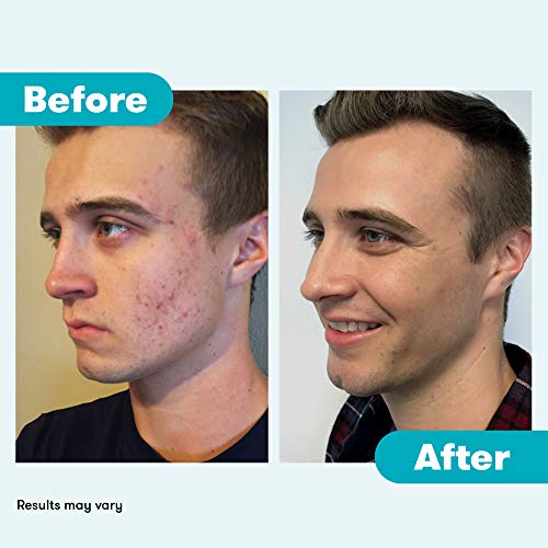 Benzoyl Peroxide Face Wash, Acne Skin Care Kit