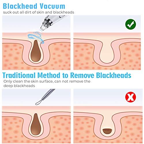 2022 Newest Blackhead Remover Pore Vacuum,Upgraded Facial Pore Cleaner